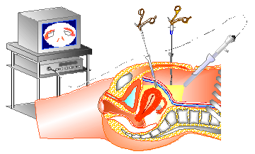 腹腔鏡下手術のイメージ