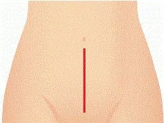 従来の開腹手術