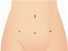 腹腔鏡の創部
