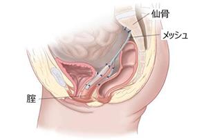 仙骨腟固定術